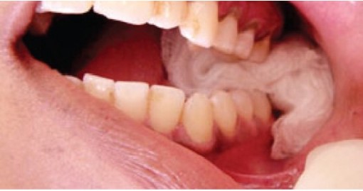 màng trắng sau khi nhổ răng, màng trắng sau khi nhổ răng là gì, xuất hiện màng trắng sau khi nhổ răng, dấu hiệu nhiễm trùng sau khi nhổ răng, sưng nướu sau khi nhổ răng, nhổ răng bị mưng mủ, nhiễm trùng sau khi nhổ răng, nhiễm trùng sau nhổ răng, Mảng trắng sau nhổ răng, chỗ nhổ răng có màu trắng, vết nhổ răng có màng trắng, ổ răng sau nhổ có mùi hôi, nhổ răng bị nhiễm trùng, nhổ răng khôn bị nhiễm trùng, dấu hiệu bị nhiễm trùng khi nhổ răng khôn, dấu hiệu nhiễm trùng sau khi nhổ răng khôn, dấu hiệu của nhiễm trùng răng, dấu hiệu viêm nhiễm sau nhổ răng, lớp màng trắng sau khi nhổ răng, màng trắng sau khi nhổ răng khôn, xuất hiện lớp màng trắng sau khi nhổ răng