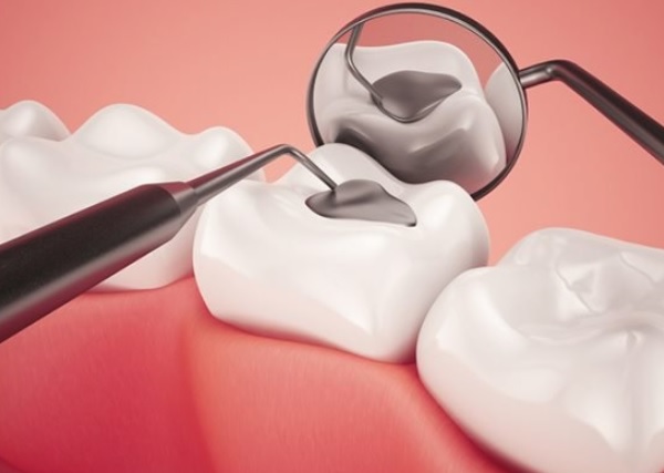quy trình trám răng sâu, quy trình trám răng cửa, quy trình trám răng thưa, quy trình trám răng mẻ, quy trình trám răng bằng composite, quy trình trám răng lấy tuỷ, quy trình trám răng, quy trình trám răng composite, quy trình trám răng thẩm mỹ