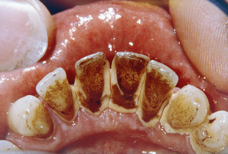 răng sứ có bị mảng bám