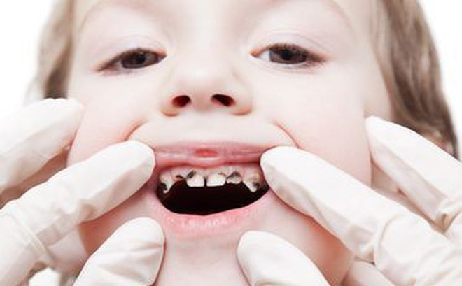 nguyên nhân gây sâu răng ở người lớn, nguyên nhân gây sâu răng, nguyên nhân gây sâu răng ở trẻ, nguyên nhân làm sâu răng, nguyên nhân gây ra sâu răng, nguyên nhân gây bệnh sâu răng, các nguyên nhân gây sâu răng, những nguyên nhân gây sâu răng, nguyên nhân gây bệnh sâu răng ở trẻ, nguyên nhân gây ra bệnh sâu răng
