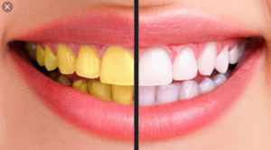 tẩy trắng răng giá, tẩy trắng răng tại nhà, tẩy trắng răng nha khoa, giá lấy cao răng và tẩy trắng răng, lấy cao răng và tẩy trắng răng, lấy cao răng miễn phí, lấy cao răng miễn phí 2019, lấy cao răng miễn phí ở hà nội, lấy cao răng miễn phí 2018, lấy cao răng miễn phí hà nội, Lấy cao răng miễn phí, lấy cao răng, lấy cao răng tại nhà, lấy cao răng bao nhiêu tiền, có nên lấy cao răng, lấy cao răng có tốt k, lấy cao răng giá, có nên lấy cao răng không, có nên lấy cao răng ko, có nên lấy cao răng k, lấy cao răng hà nội, lấy cao răng là gì, cách lấy cao răng lâu năm, lấy cao răng bằng máy siêu âm, lấy cao răng siêu âm, lấy cao răng như thế nào, lấy cao răng miễn phí, có nên lấy cao răng thường xuyên không, lưu ý sau khi lấy cao răng, lấy cao răng mất bao lâu, lấy cao răng mất bao nhiêu tiền, lấy cao răng để làm gì, có bầu lấy cao răng được không, cách lấy cao răng lâu năm tại nhà, lấy cao răng tphcm, có nên lấy cao răng hay không, bao lâu lấy cao răng 1 lần, lấy cao răng nhiều có tốt không, lấy cao răng ở đâu tốt tphcm, máy lấy cao răng siêu âm, lấy cao răng bị ê buốt, lấy cao răng bao lâu, lấy cao răng bị chảy máu, lấy cao răng bằng sóng siêu âm, lấy cao răng hết bao nhiêusĩ, lấy cao răng ở hà nội giá bao nhiêu, lấy cao răng làm trắng răng, có nên lấy cao răng thường xuyên, có nên lấy cao răng định kỳ, lưu ý khi lấy cao răng, mấy tháng lấy cao răng 1 lần, lấy cao răng và đánh bóng, lấy cao răng và làm trắng, lấy cao răng cầu giấy, lấy cao răng có lợi hay hại, lấy cao răng có đắt không, lấy cao răng có tốt hay không, lấy cao răng giá rẻ, lấy cao răng kiêng gì, lấy cao răng làm gì, lấy cao răng hết bao tiền, lấy cao răng là như thế nào, lấy cao răng mấy tháng một lần, lấy cao răng ở đâu tốt, lấy cao răng ở đâu hà nội, lấy cao răng có phải kiêng gì không, lấy cao răng tại hải phòng, lấy cao răng uy tín ở hà nội, giá lấy cao răng uy tín ở hà nội, địa chỉ lấy cao răng uy tín, lấy cao răng răng có trắng hơn không, lấy cao răng tại hà nội, lấy cao răng và tẩy trắng răng, lấy cao răng có đau không webtretho, bao lâu nên lấy cao răng 1 lần, lấy cao răng hà nội giá, lấy cao răng giá rẻ tại hà nội, lấy cao răng có đau, lấy cao răng bn tiền, ê răng sau khi lấy cao răng, giá 1 lần lấy cao răng, chi phí 1 lần lấy cao răng, giá tiền 1 lần lấy cao răng, chi phí cho 1 lần lấy cao răng, lấy cao răng an toàn, lấy cao răng ở đâu an toàn, lấy cao răng bằng siêu âm, lấy cao răng công nghệ mới, lấy cao răng cho trẻ em, lấy cao răng có hại gì không, lấy cao răng cần kiêng gì, lấy cao răng chi phí bao nhiêu, lấy cao răng có giúp trắng răng không, lấy cao răng giá bn, lấy cao răng giá bao tiền, lấy cao răng giá rẻ ở hà nội, lấy cao răng hcm, lấy cao răng hết bn tiền, lấy cao răng khoảng bao nhiêu tiền, lấy cao răng khi mang thai, lấy cao răng lợi hay hại, lấy cao răng lần đầu, lấy cao răng làm trắng răng giá bao nhiêu, lấy cao răng mất bao tiền, lấy cao răng miễn phí 2019, lấy cao răng miễn phí ở hà nội, lấy cao răng mất bao nhiêu, lấy cao răng nhiều có hại không, lấy cao răng như thế nào là tốt, lấy cao răng ở đâu tốt hà nội, lấy cao răng ở thủ đức, lấy cao răng xong có phải kiêng gì không, lấy cao răng uy tín ở tphcm, lấy cao răng uy tín tại hà nội, chỗ lấy cao răng uy tín ở hà nội, chỗ lấy cao răng uy tín, lấy cao răng ở đâu uy tín, lấy cao răng có giúp răng trắng hơn