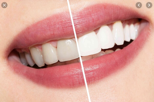 tẩy trắng răng có hại k, tẩy trắng răng có hại không webtretho, tẩy trắng răng có hại như thế nào, tẩy trắng răng có hại cho sức khỏe không, thuốc tẩy trắng răng có hại gì không, bút tẩy trắng răng có hại không, kem tẩy trắng răng có hại không, bột tẩy trắng răng có hại không, thuốc tẩy trắng răng có hại không, tẩy trắng răng có hại không, tẩy trắng răng có hại, tẩy trắng răng có hại gì không, tẩy trắng răng có hại ko, tẩy trắng răng có hại hay không, tẩy trắng răng có hại gì, tẩy trắng răng có hại cho răng không, tẩy trắng răng có hại răng không, Tẩy trắng răng có hại