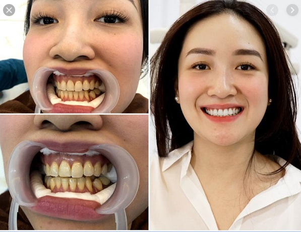 tẩy trắng răng có hại k, tẩy trắng răng có hại không webtretho, tẩy trắng răng có hại như thế nào, tẩy trắng răng có hại cho sức khỏe không, thuốc tẩy trắng răng có hại gì không, bút tẩy trắng răng có hại không, kem tẩy trắng răng có hại không, bột tẩy trắng răng có hại không, thuốc tẩy trắng răng có hại không, tẩy trắng răng có hại không, tẩy trắng răng có hại, tẩy trắng răng có hại gì không, tẩy trắng răng có hại ko, tẩy trắng răng có hại hay không, tẩy trắng răng có hại gì, tẩy trắng răng có hại cho răng không, tẩy trắng răng có hại răng không, Tẩy trắng răng có hại