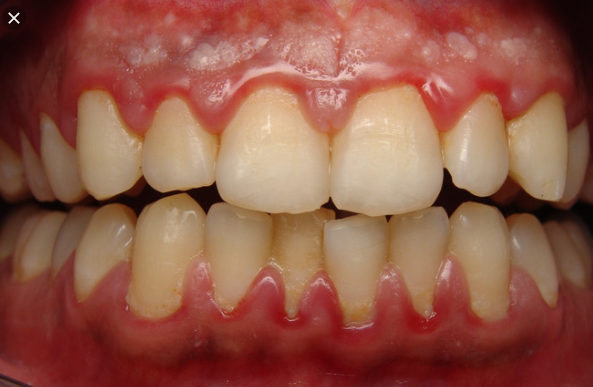 nướu răng nổi mụn nước, nướu răng bị nổi mụn, mụn ở nướu răng, nướu răng nổi mụn, nướu răng bị nổi mụn nước, nướu răng mọc mụn, áp xe chân răng, mọc mụn mủ ở lợi, nổi mụn trắng ở nướu răng, nổi mụn ở nướu răng, mọc mụn ở chân răng, mọc mụn ở lợi trên, bé bị nổi mụn ở nướu răng, nổi mụn thịt ở nướu răng, mọc mụn ở nướu răng, mọc mụn ở lợi
