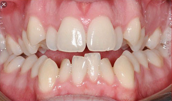 răng bị lồi sĩ, răng lồi xỉ, nhổ răng lồi xỉ, hình ảnh răng lồi xỉ, niềng răng lồi xỉ, răng lòi sĩ, nhổ răng lòi sĩ, răng khểnh và răng lòi sĩ, niềng răng lòi sĩ, cách trị răng lòi sĩ, hình ảnh răng lòi sĩ