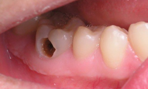 viêm tủy răng ở trẻ em, điều trị viêm tủy răng ở trẻ em, bệnh viêm tủy răng ở trẻ em, cách điều trị viêm tủy răng ở trẻ em, viêm tủy răng ở trẻ, viêm tủy răng ở trẻ nhỏ, Viêm tủy răng ở trẻ, trẻ bị viêm tủy răng, viêm tủy răng trẻ em, viêm tủy răng ở trẻ nhỏ, viêm tủy răng sữa ở trẻ, viêm tủy răng sữa, cách điều trị viêm tủy răng