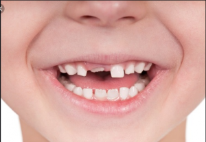 thay răng sữa, thay răng sữa bao lâu thì mọc, tuổi thay răng sữa, trình tự thay răng sữa, trẻ chậm thay răng sữa, trẻ thay răng sữa, lịch thay răng sữa, mấy tuổi thay răng sữa, thứ tự thay răng sữa, thay răng sữa ở trẻ, bé thay răng sữa, bé 5 tuổi thay răng sữa, trẻ 7 tuổi chưa thay răng sữa, trẻ em thay răng sữa lúc mấy tuổi, thay răng sữa, thay răng sữa bao lâu thì mọc, tuổi thay răng sữa, trình tự thay răng sữa, trẻ chậm thay răng sữa, trẻ thay răng sữa, lịch thay răng sữa, mấy tuổi thay răng sữa, thứ tự thay răng sữa, thay răng sữa ở trẻ, bé thay răng sữa, bé 5 tuổi thay răng sữa, trẻ 7 tuổi chưa thay răng sữa, trẻ em thay răng sữa lúc mấy tuổi, thay răng sữa, thay răng sữa bao lâu thì mọc, tuổi thay răng sữa, trình tự thay răng sữa, trẻ chậm thay răng sữa, trẻ thay răng sữa, lịch thay răng sữa, mấy tuổi thay răng sữa, thứ tự thay răng sữa, thay răng sữa ở trẻ, bé thay răng sữa, bé 5 tuổi thay răng sữa, trẻ 7 tuổi chưa thay răng sữa, trẻ em thay răng sữa lúc mấy tuổi, thay răng sữa, thay răng sữa bao lâu thì mọc, tuổi thay răng sữa