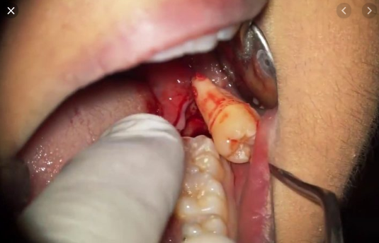 biến chứng nhổ răng khôn, biến chứng nhổ răng số 8, biến chứng nhổ răng, biến chứng nhổ răng khôn hàm trên, biến chứng sau nhổ răng, biến chứng sau nhổ răng khôn, biến chứng sau nhổ răng số 8, những biến chứng sau nhổ răng khôn, các biến chứng sau nhổ răng, biến chứng sau khi nhổ răng khôn, biến chứng sau khi nhổ răng số 8, những biến chứng sau khi nhổ răng khôn, những biến chứng sau khi nhổ răng
