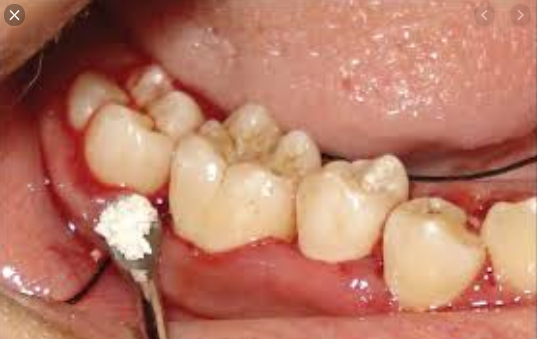 răng số 7 bị lung lay, răng số 7 lung lay, chữa răng số 7 lung lay, nhổ răng khôn làm răng số 7 lung lay