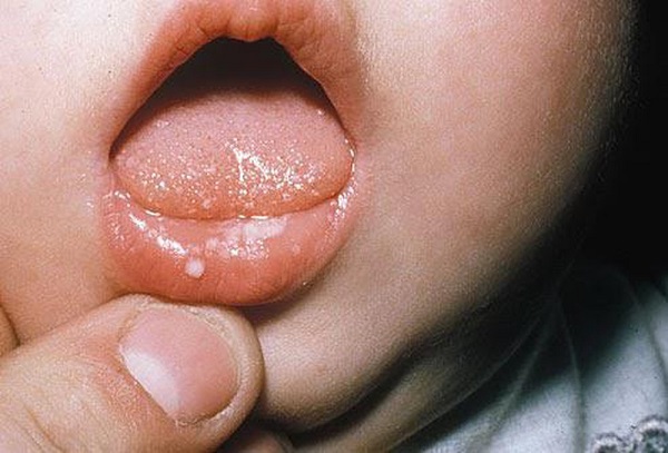 nhiệt miệng ở trẻ dưới 1 tuổi, trẻ bị nhiệt miệng và sốt, trẻ sơ sinh 1 tháng tuổi bị nhiệt miệng, cách trị nhiệt miệng cho trẻ sơ sinh, hình ảnh nhiệt miệng ở trẻ