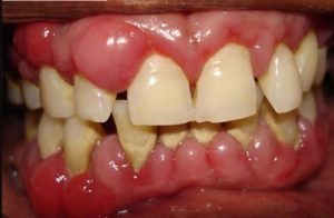 viêm nướu răng có mủ, bị viêm nướu răng có mủ, viêm nướu răng có mủ ở trẻ, viêm lợi răng khôn có mủ, bị viêm nướu răng có mủ, trẻ bị sưng nướu răng có mủ